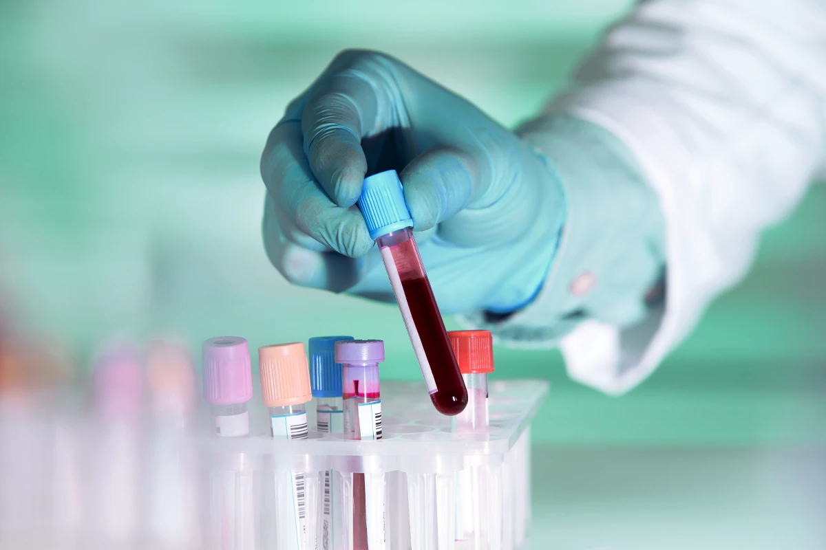 Behandlung Allergietest Blutuntersuchung Eine Hand in Latexhandschuh hebt eine blugefĂĽlltes Reagenzglas aus einem Halter hoch