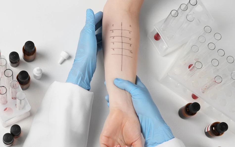 behandlung-allergietest-ursachen-finden An einem Arm wird ein Pricktest druchgeführt. Drum herum sind Reagenzgläser in Haltern