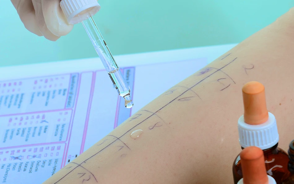 An einem Arm wird ein Pricktest druchgeführt.