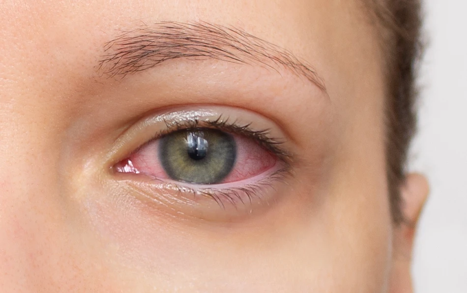 Typische Symptome Heuschnupfen rote Augen Nahaufnahme eines geröteten Auges