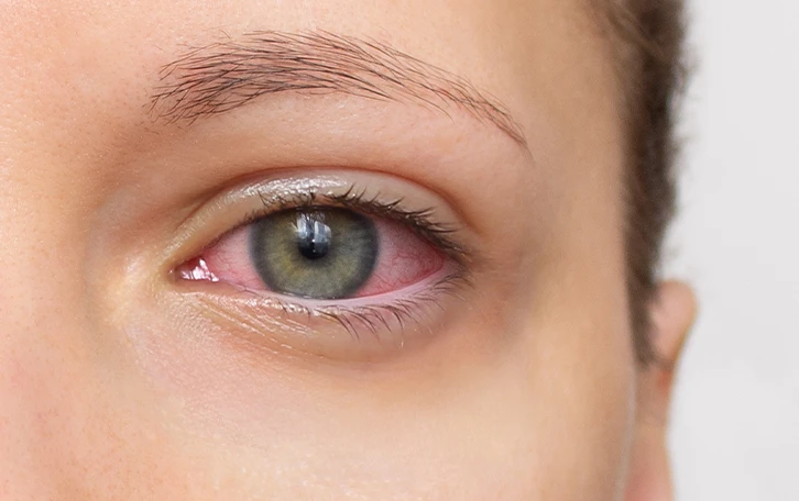 verringert-allergische-reaktionen-nase-augen Nahaufnahme eines geröteten Auges